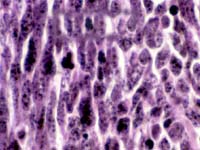 small-cell lung cancer
