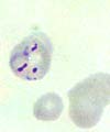 Ring form of Plasmodium falciparum