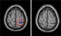 Brain function linked to birth size in new study
