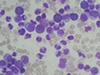 Researchers announce critical leukaemia stem cell discovery