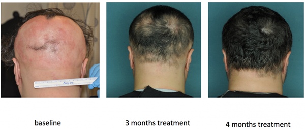 FDA-approved drug restores hair in patients with Alopecia Areata