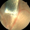 Prosthetic retina offers simple solution to restoring sight