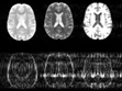 New algorithm could substantially speed up MRI scans